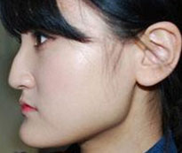 地包天影响面容美观