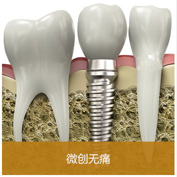 Nobel即刻种植牙微创无痛