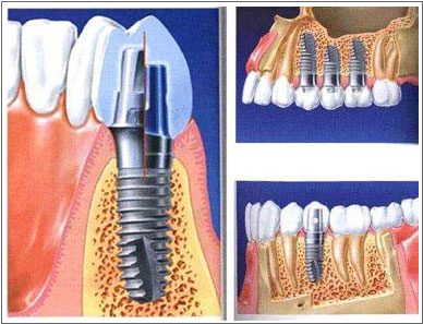 Nobel即刻种植牙