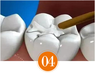 补牙材质填充